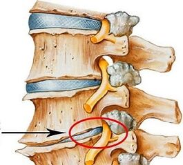 De ce este osteochondroza lombară