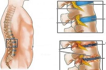 Motivele dezvoltării osteochondrozei lombare