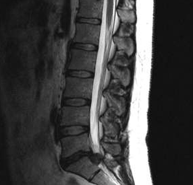 Opțiuni de diagnostic pentru osteochondroza lombară