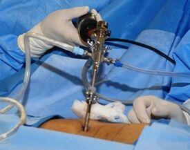 Tratamentul chirurgical al osteocondrozei lombare