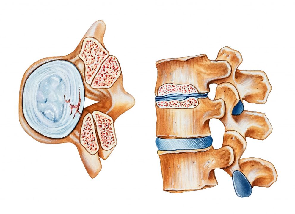 Osteochondroza regiunii cervicale duce la distrugerea discurilor intervertebrale