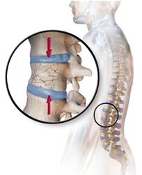 Osteoporoza provoacă dureri de spate în partea inferioară a spatelui